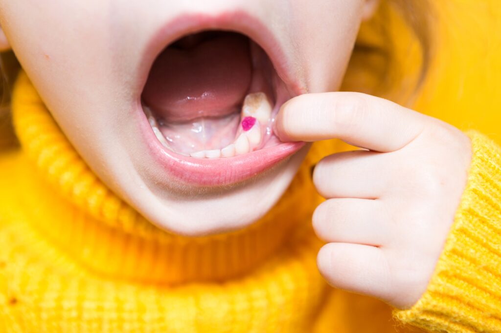 Colored purple filling on the girl's milk chewing tooth. Pediatric dentistry,