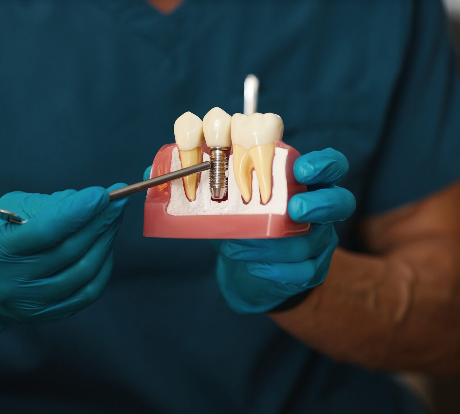 Illustrating Dental Implant Procedure On Model