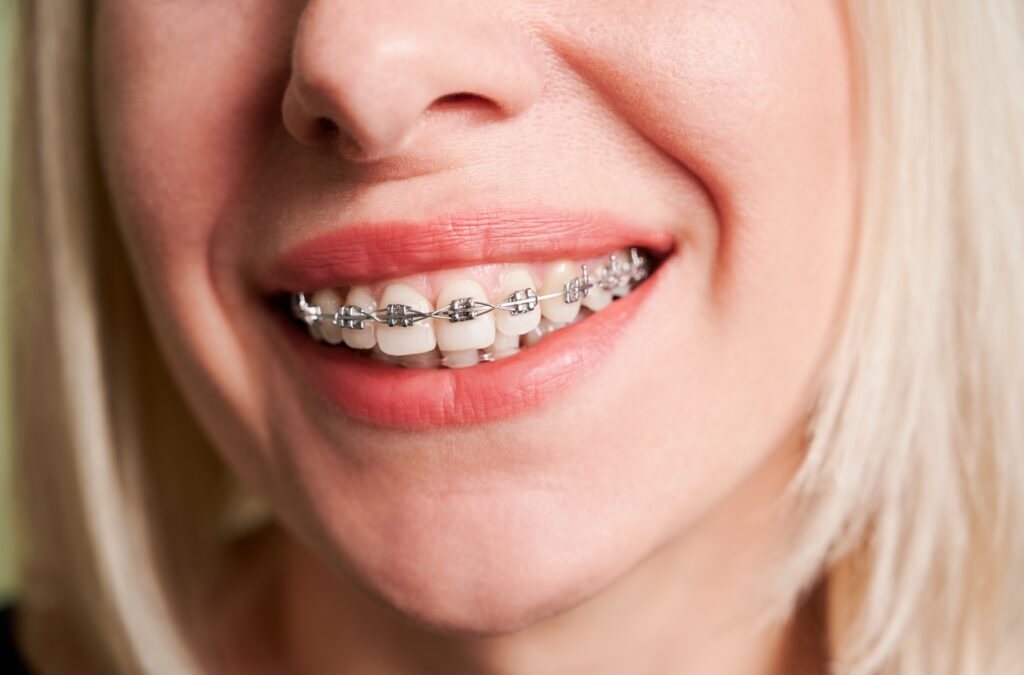 Blonde woman with metal braces on teeth.