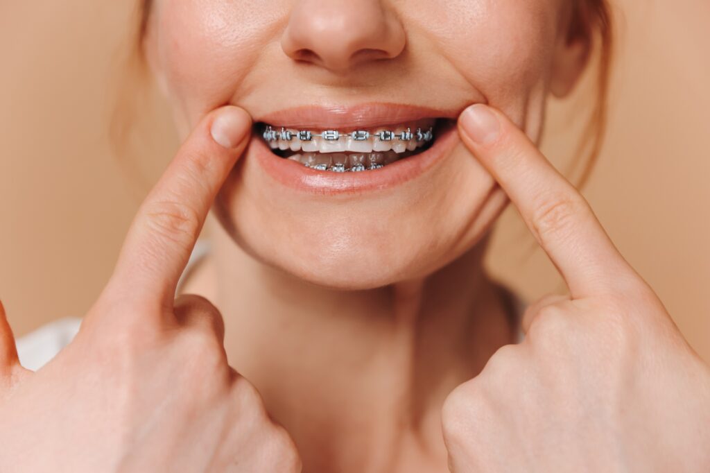 Close-up of a woman stretching a smile with her fingers and showing her braces