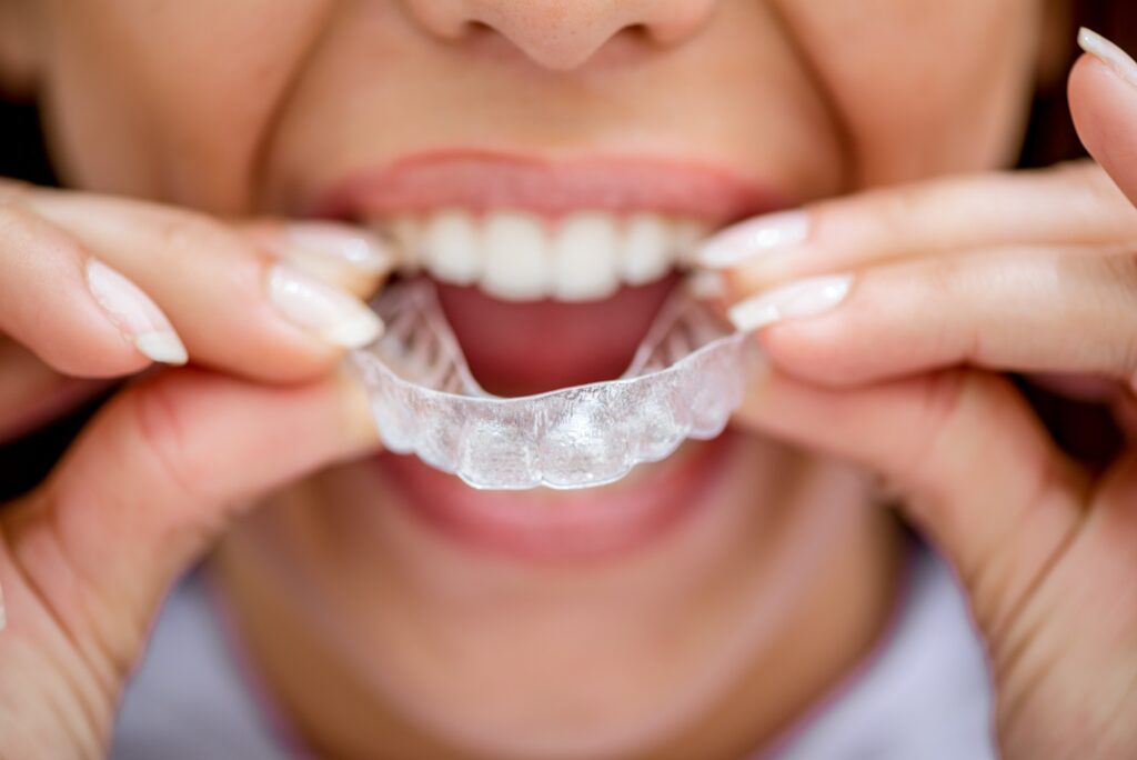 Invisible Braces